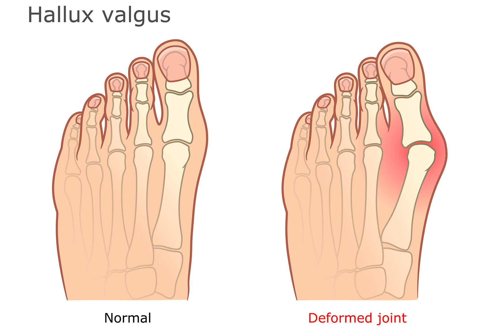 Bunions Hallux Valgus