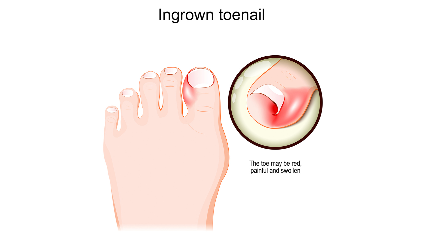 Ingrown Nail